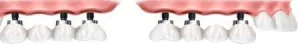 Implant dentar Bucuresti