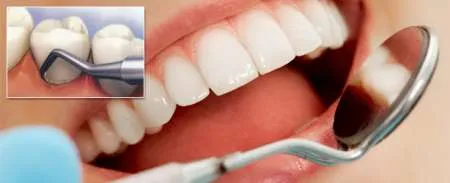 Detartraj dentar la Clinica Elveto Dent - Imaginea 1