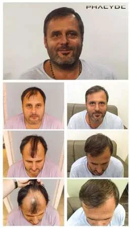 IMPLANT DE PAR - Imaginea 6