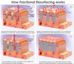 Vand aparat laser fractional co2 dermatologic/ ginecologic - Miniatura 3