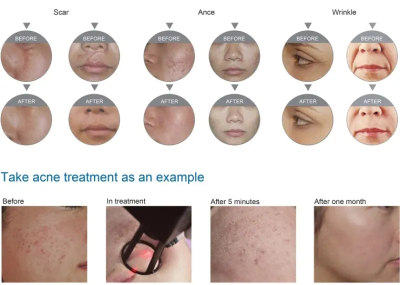 Vand aparat laser fractional co2 dermatologic/ ginecologic - Imaginea 4