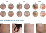 Vand aparat laser fractional co2 dermatologic/ ginecologic - Miniatura 4