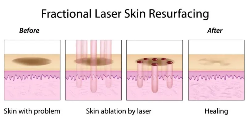 Vand aparat laser fractional co2 dermatologic/ ginecologic - Imaginea 5