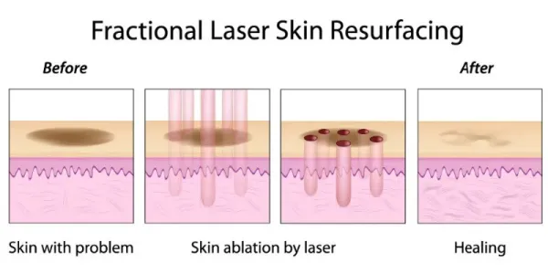 Vand aparat laser fractional co2 dermatologic/ ginecologic - Imaginea 5