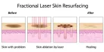 Vand aparat laser fractional co2 dermatologic/ ginecologic - Miniatura 5