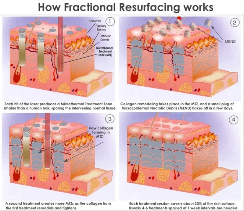 vand aparat laser fractional co2 dermatologic/ ginecologic 3